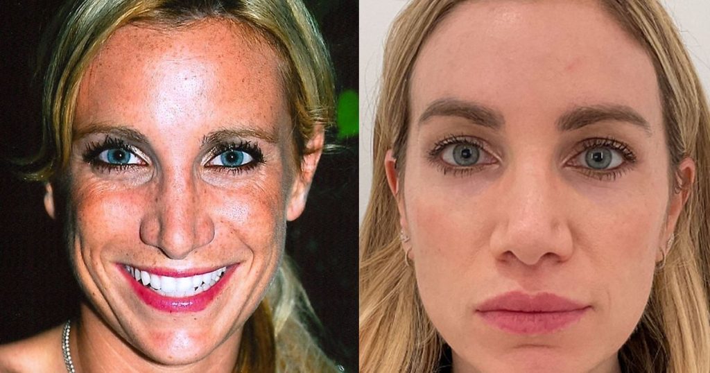 Transforming skin: a woman's $10,000 journey to banish sun spots